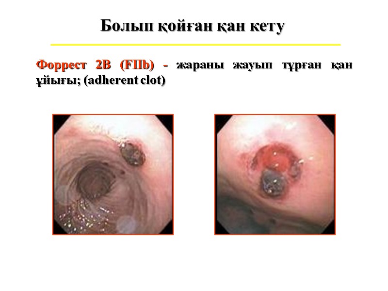 Болып қойған қан кету Форрест 2В (FIIb) - жараны жауып тұрған қан ұйығы; (adherent